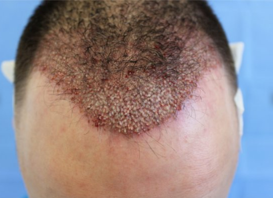 how long to regrow hair after chemo